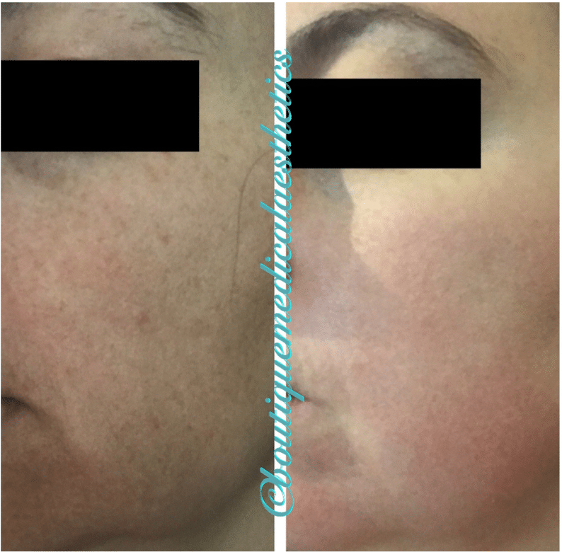 Before and After Image: ZO - front