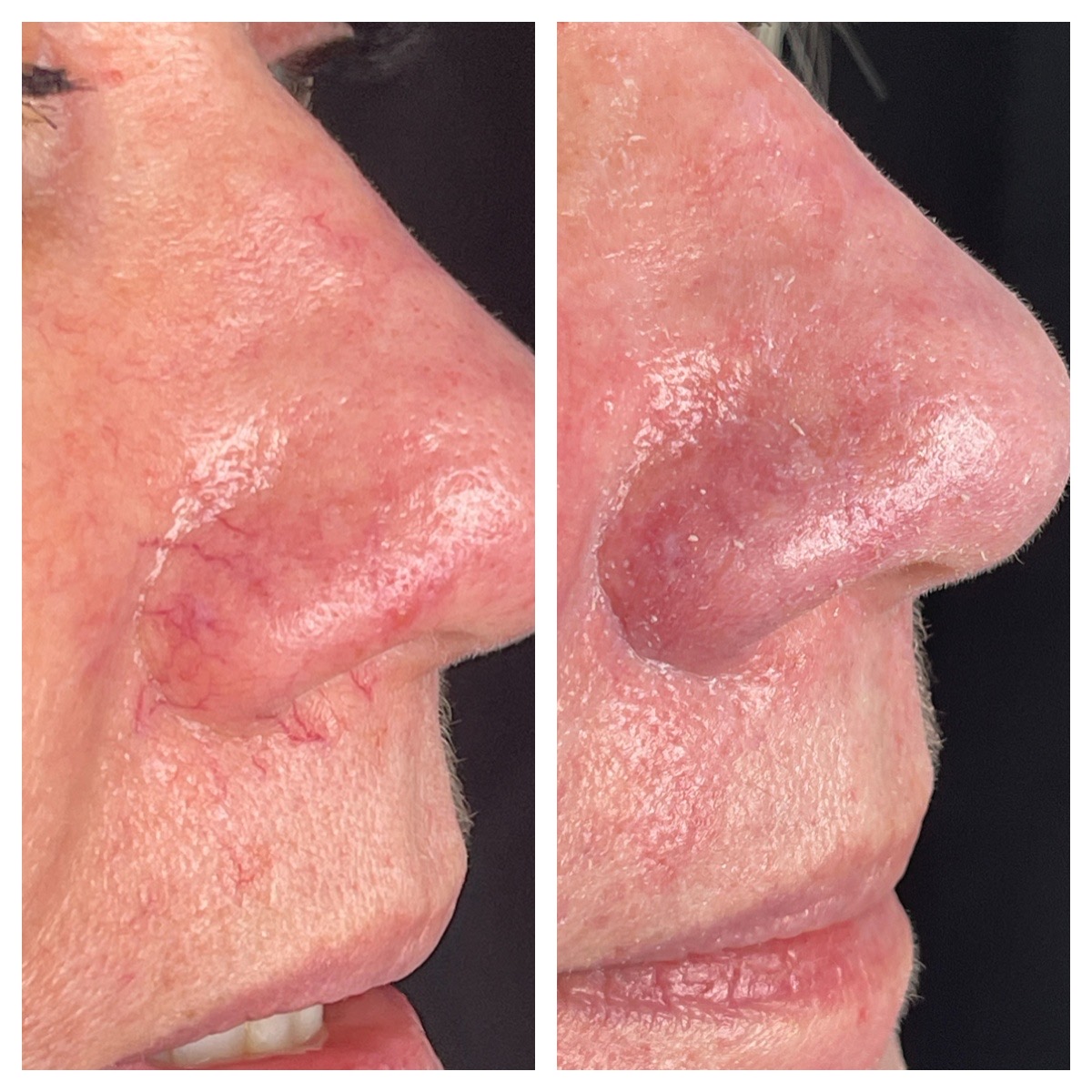 Before and After Image: BBL (Vascular) - right-side