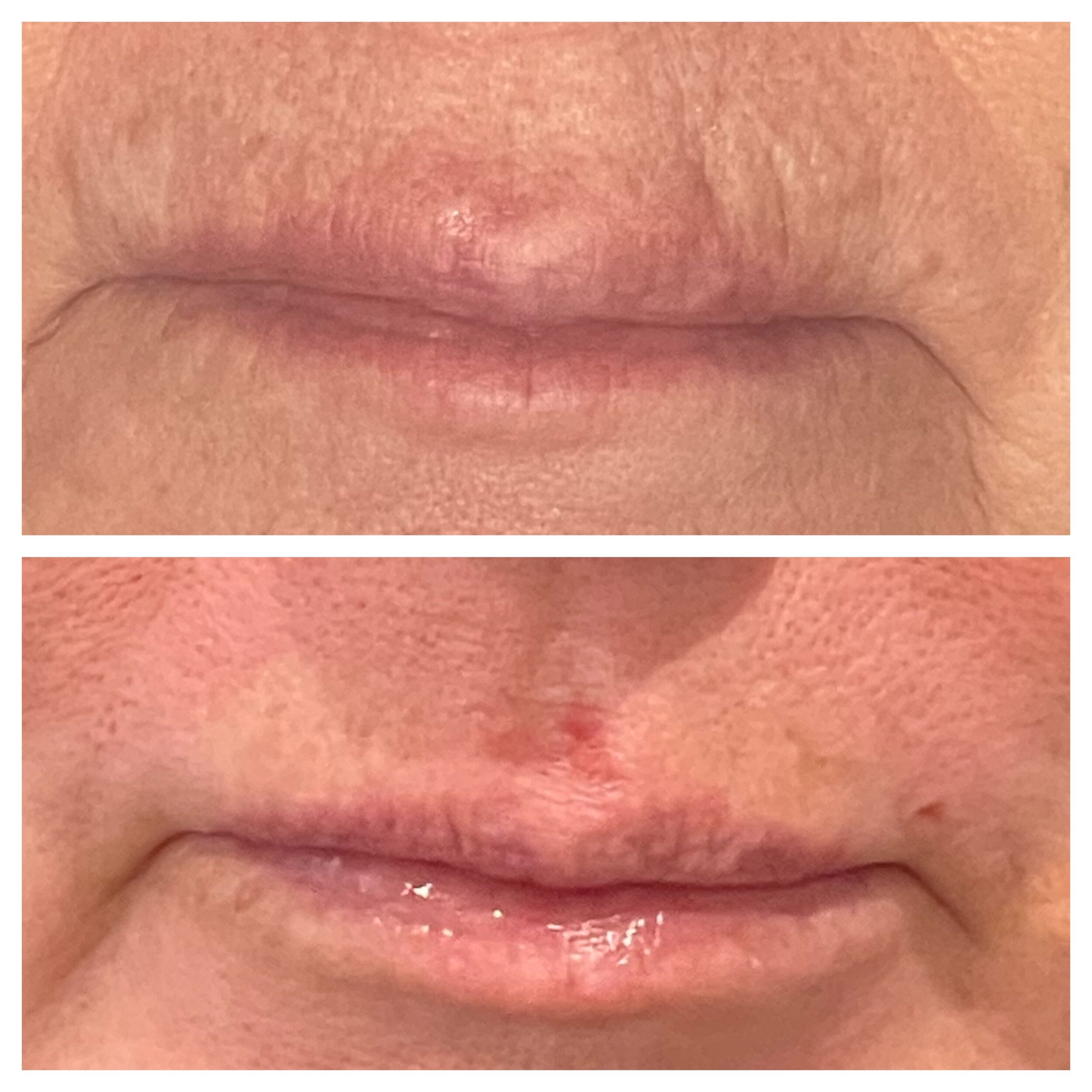 Before and After Image: Contour TRL (Perioral) - front