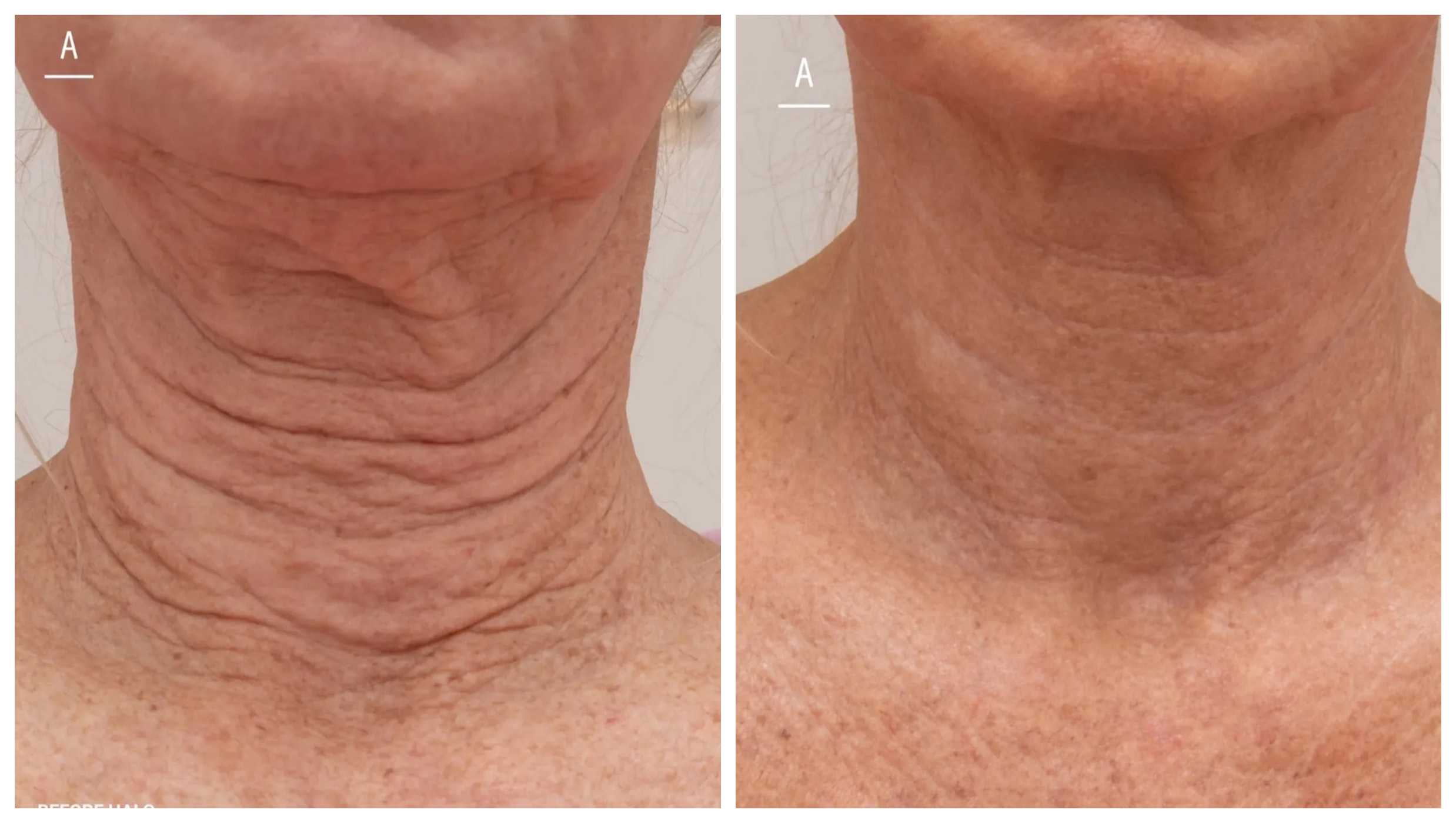 Before and After Image: HALO Neck - front