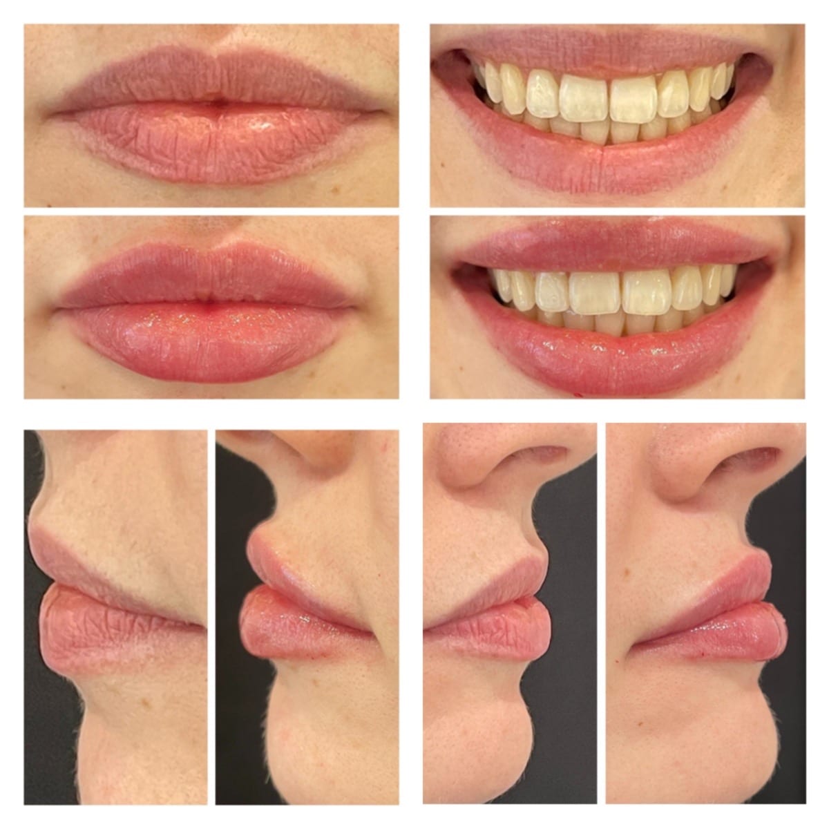 Before and After Image: Lip Filler - front