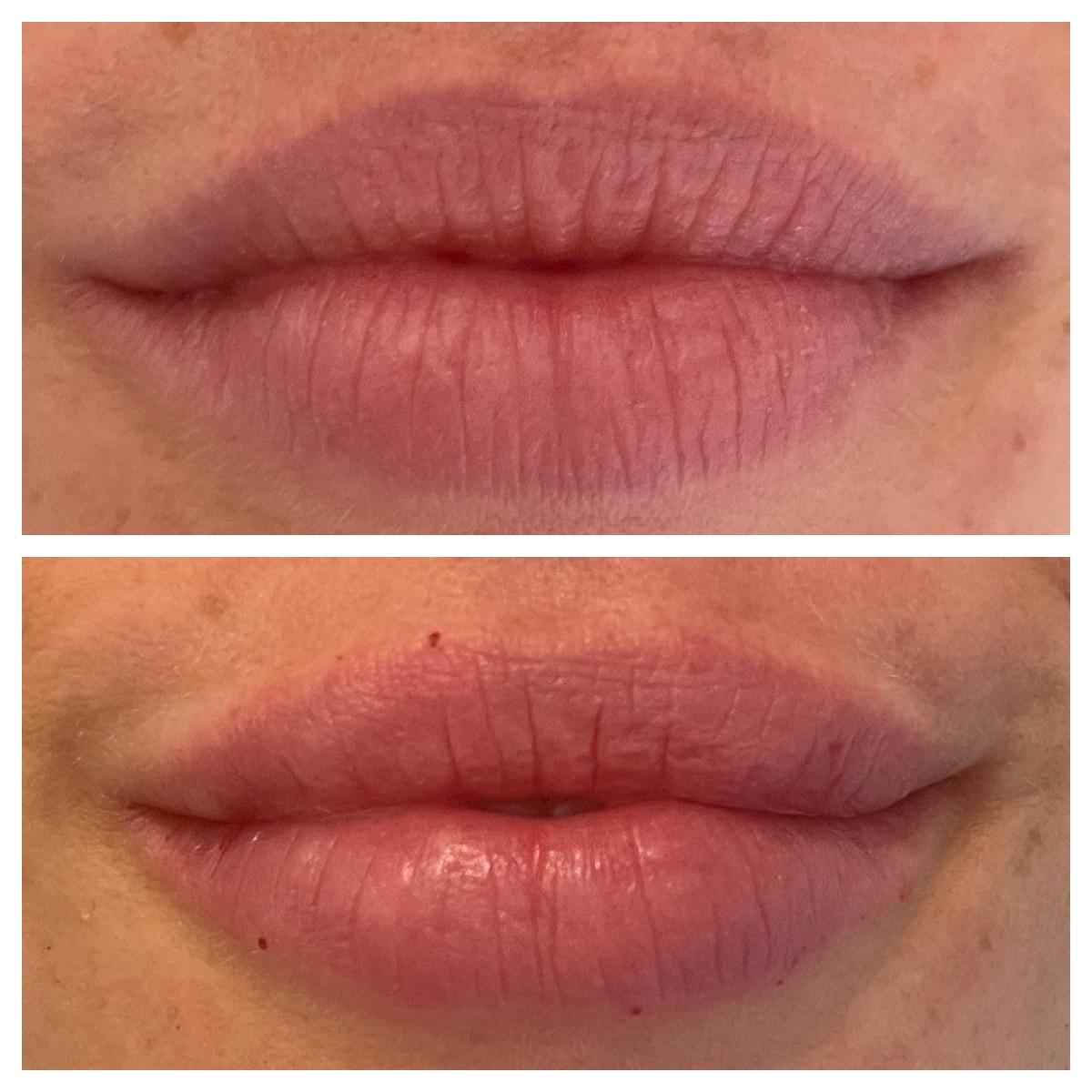 Before and After Image: Lip Filler - front