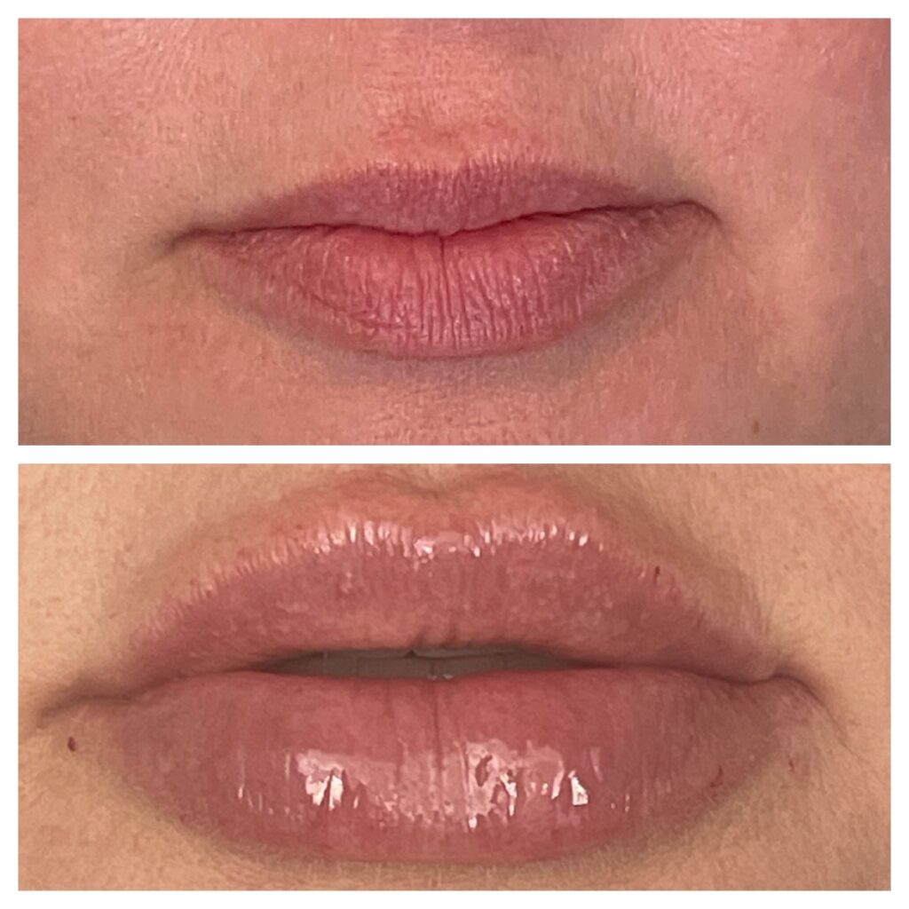 Before and After Image: Lip Filler - front