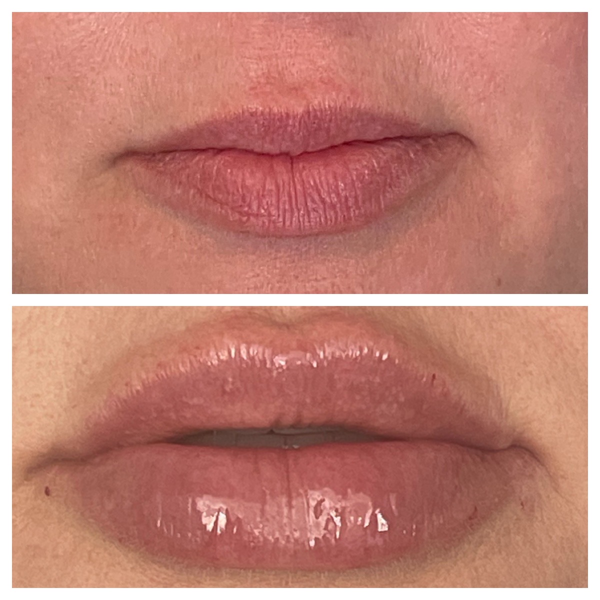Before and After Image: Lip Filler - front