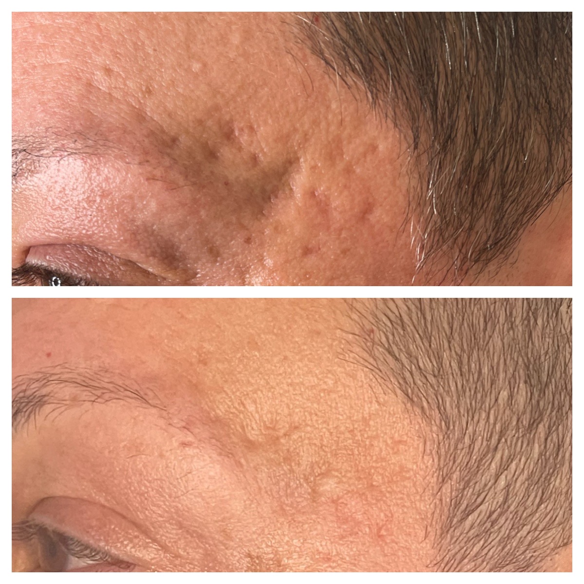 Before and After Image: Profractional LASER - left-front-oblique