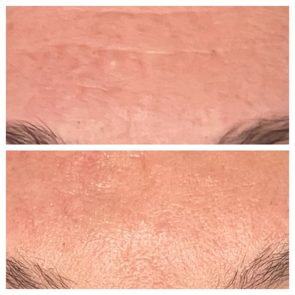 Before and After Image: Profractional LASER - front