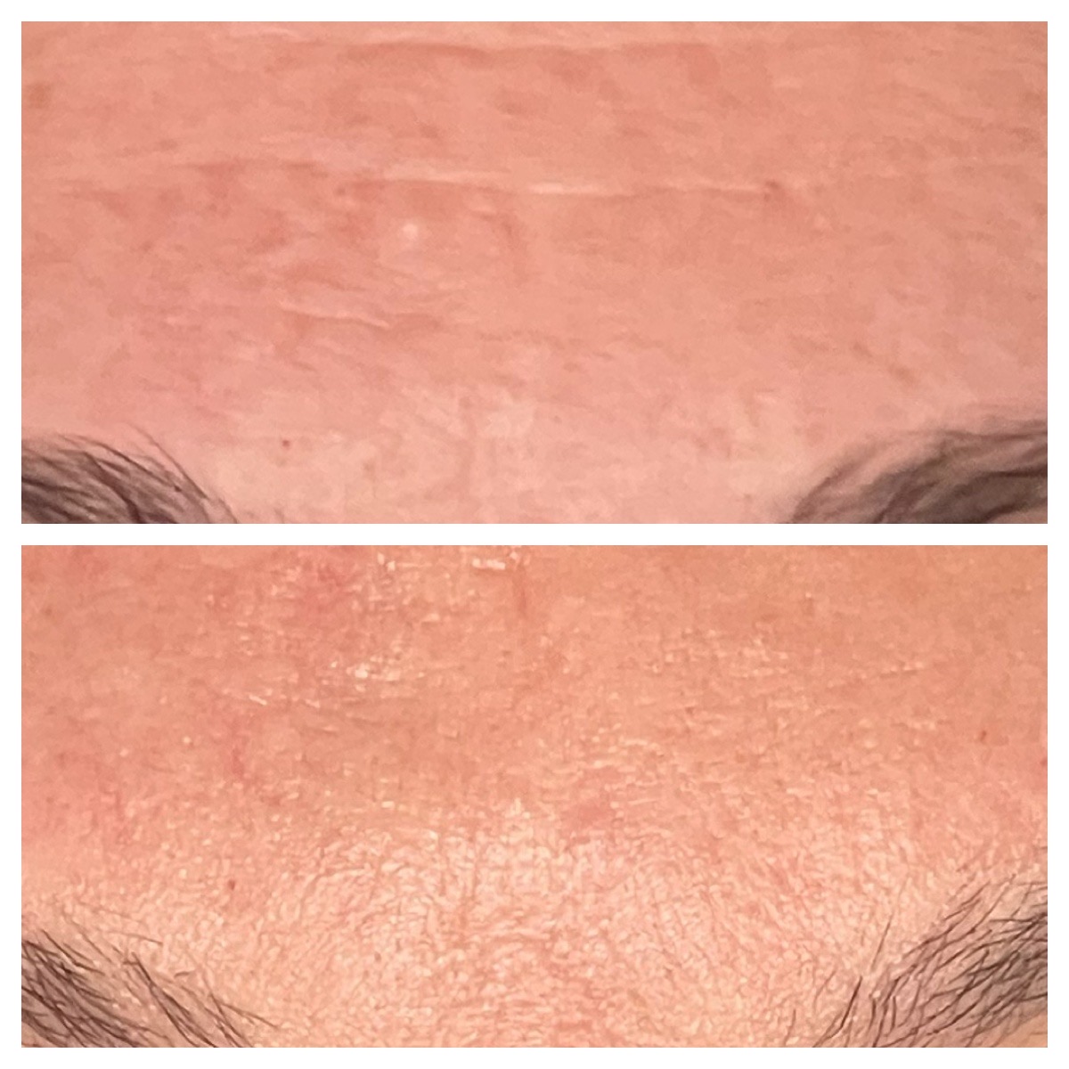 Before and After Image: Profractional LASER - front