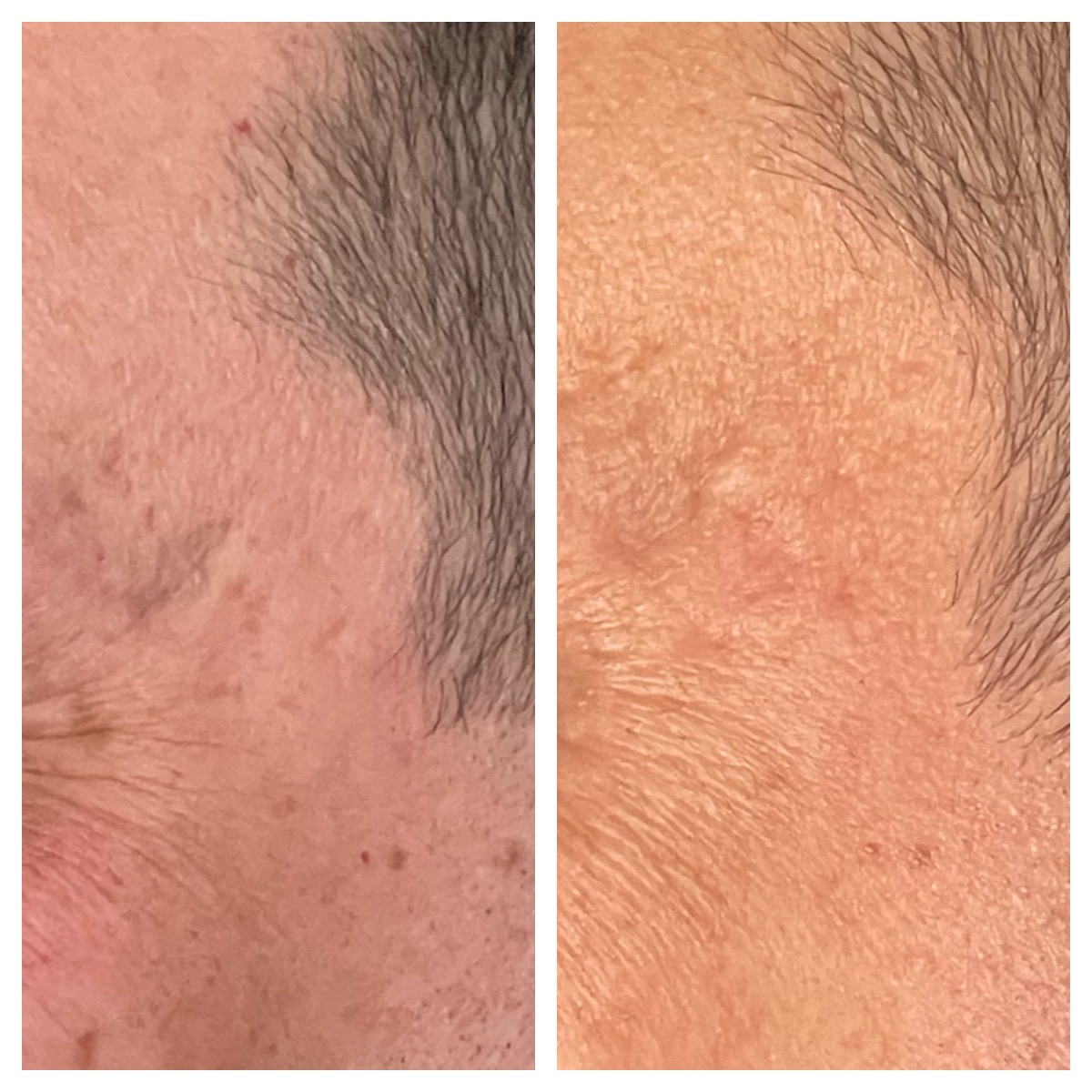 Before and After Image: Profractional LASER - left-front-oblique