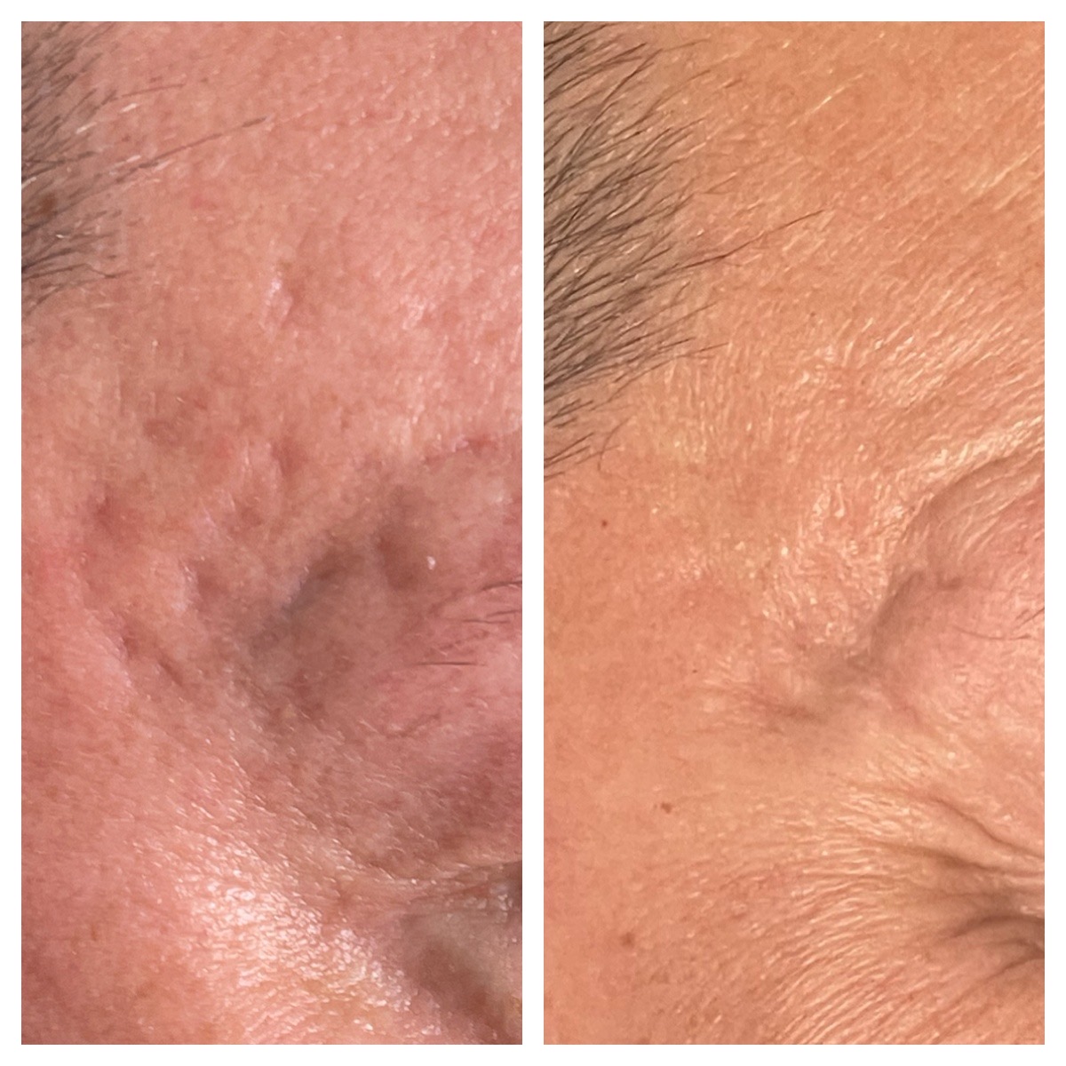 Before and After Image: Profractional LASER - front