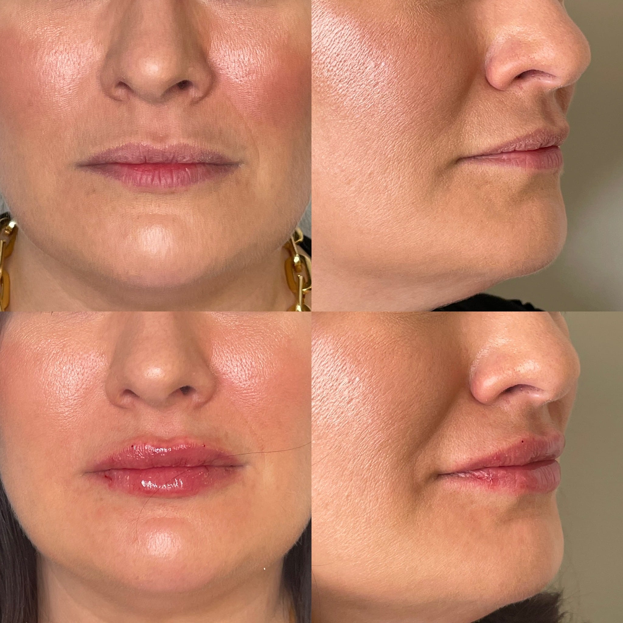 Before and After Image: Lip Filler - front
