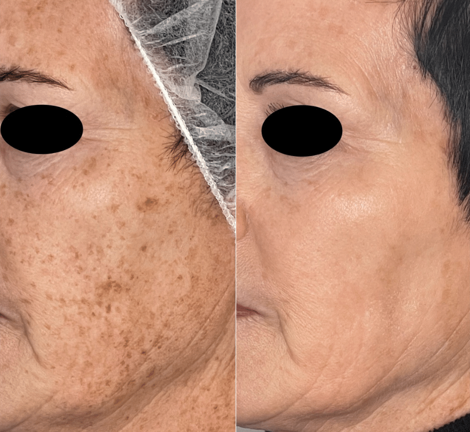 Before and After Image: Forever Young BBL - front