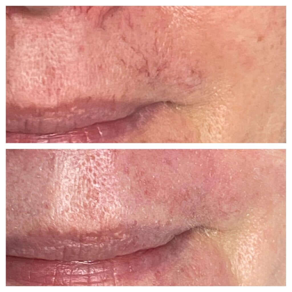 Before and After Image: BBL Vascular - front