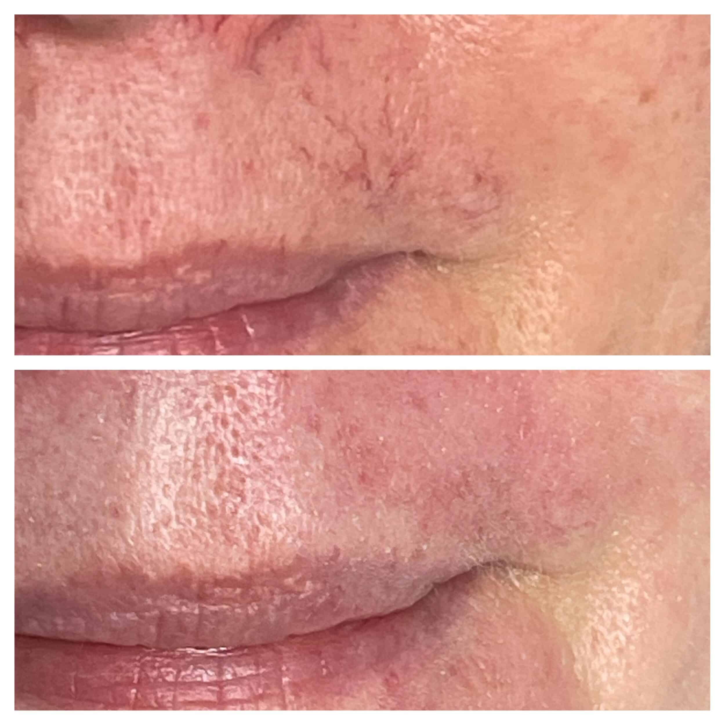 Before and After Image: BBL Vascular - front