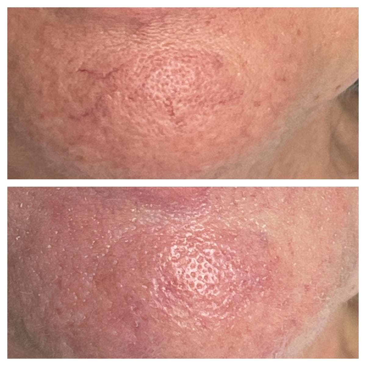 Before and After Image: BBL Vascular - front