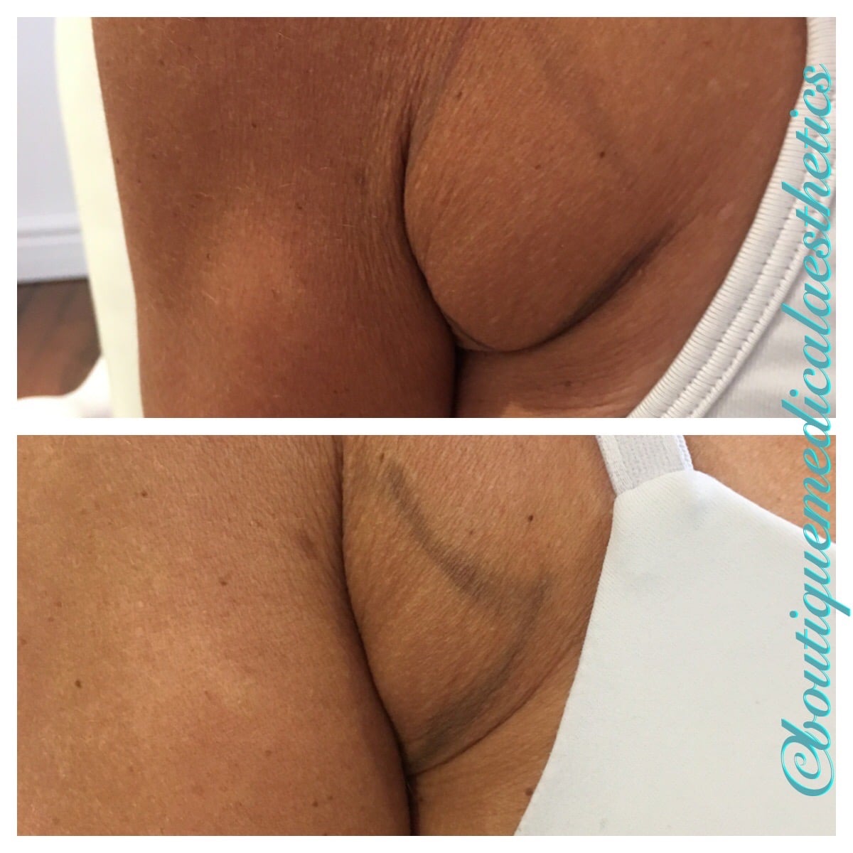 Before and After Image: Belkyra - front