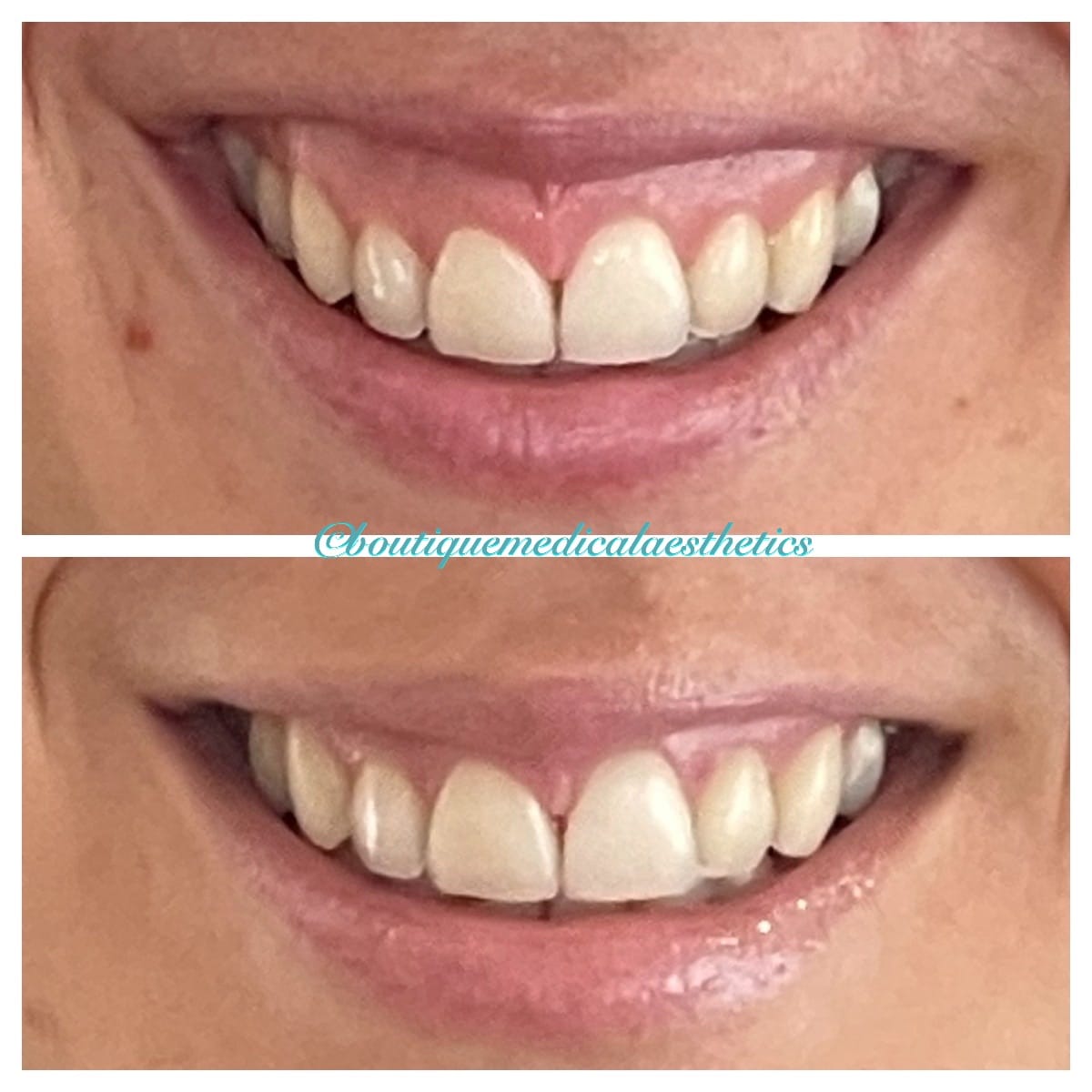 Before and After Image: Gummy Smile - front