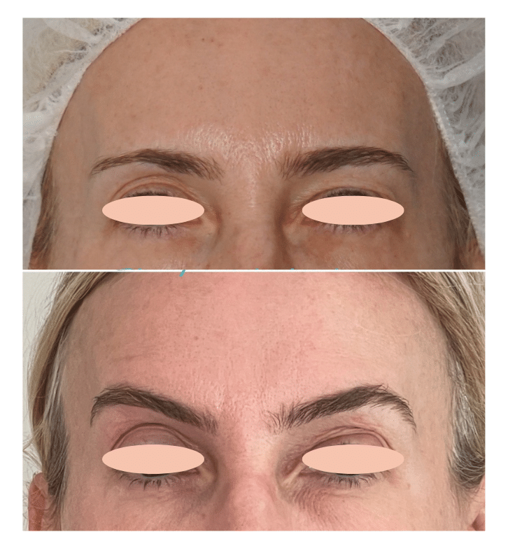 Before and After Image: Botox - front