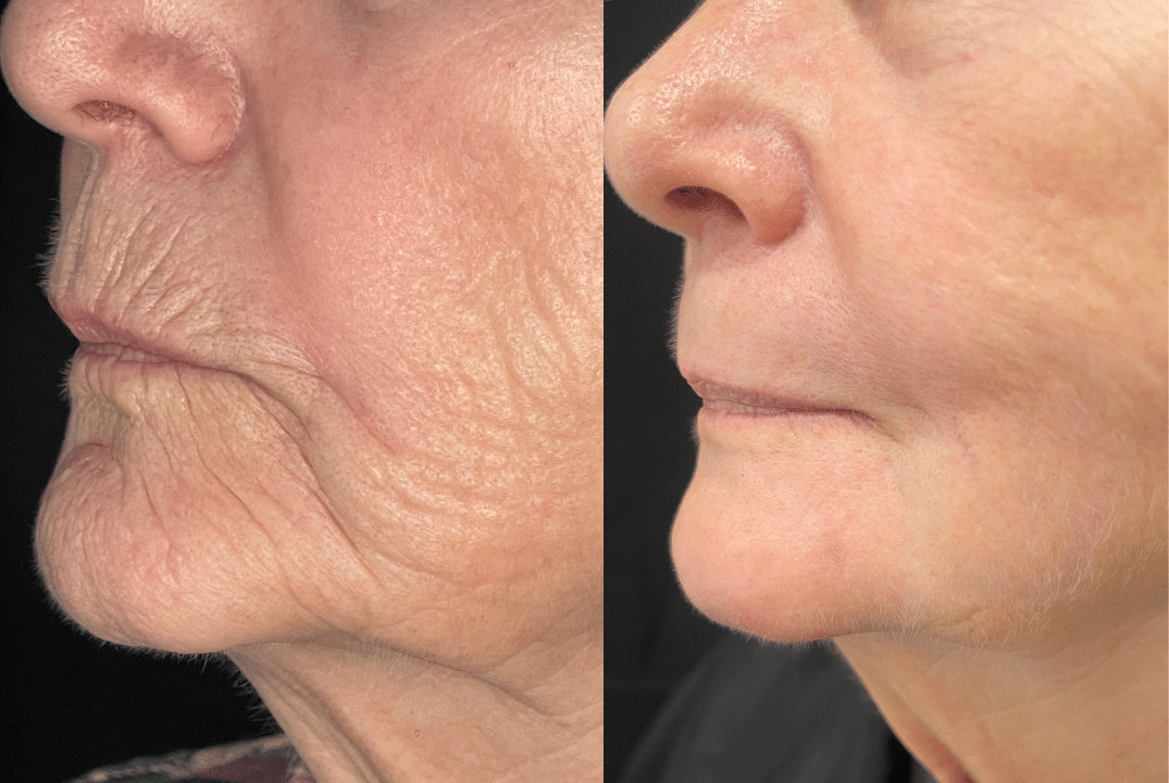 Before and After Image: Contour TRL - left-side