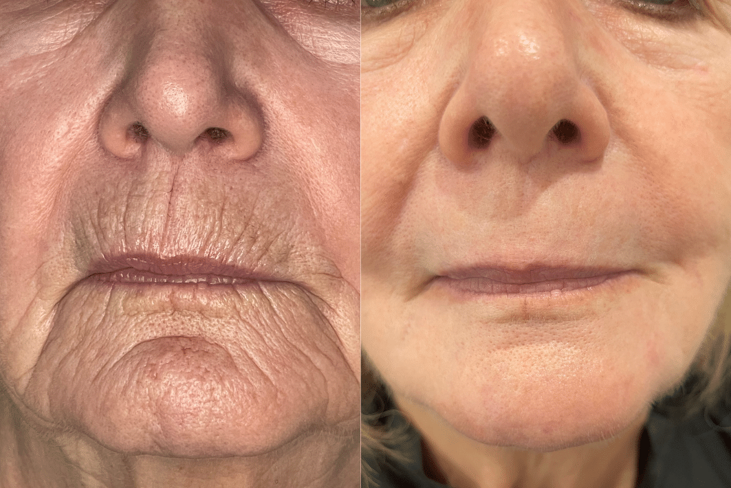 Before and After Image: Contour TRL - front