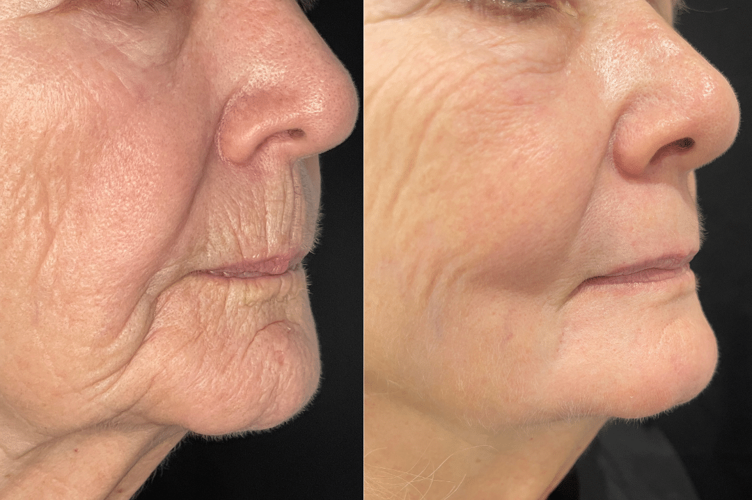 Before and After Image: Contour TRL - right-side