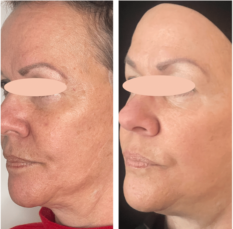 Before and After Image: Forever Young BBL and MicroLASERpeel (Arctic Peel) - left-front-oblique