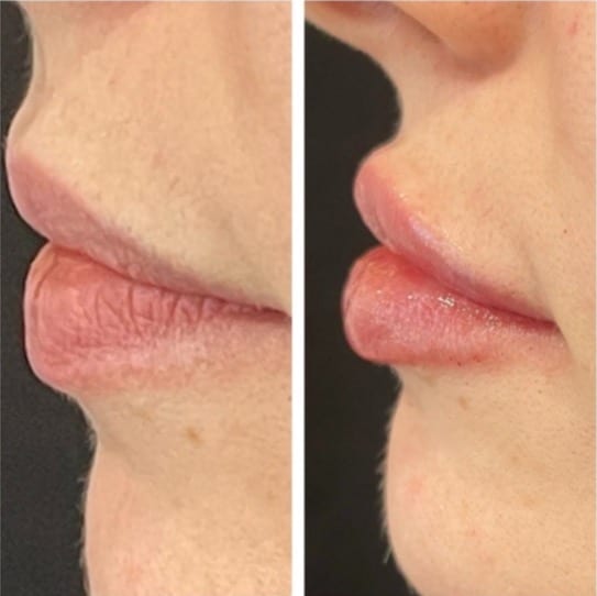 Before and After Image: Dermal Fillers - left-side