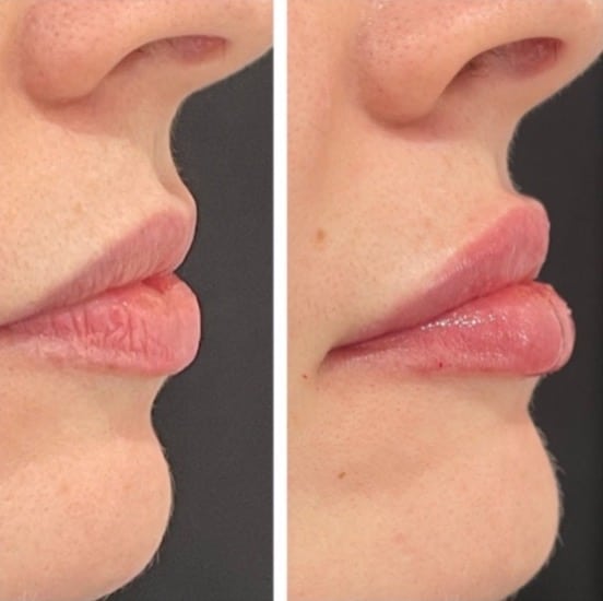 Before and After Image: Dermal Fillers - right-side