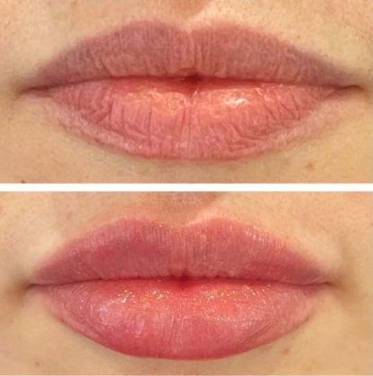 Before and After Image: Dermal Fillers - front