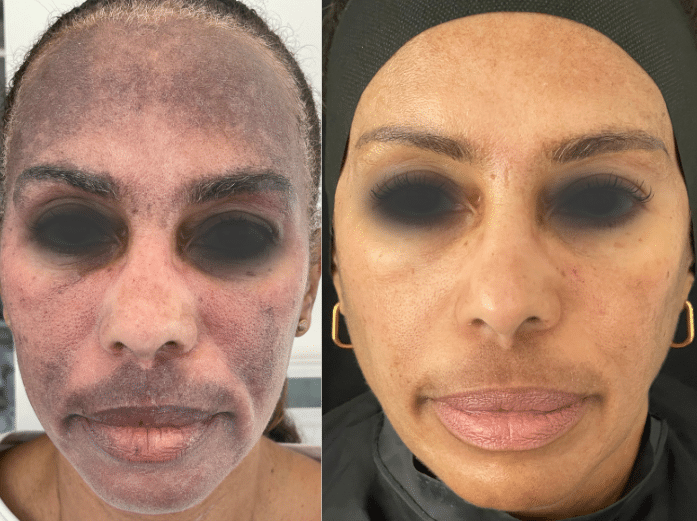 Before and After Image: Melasma - front