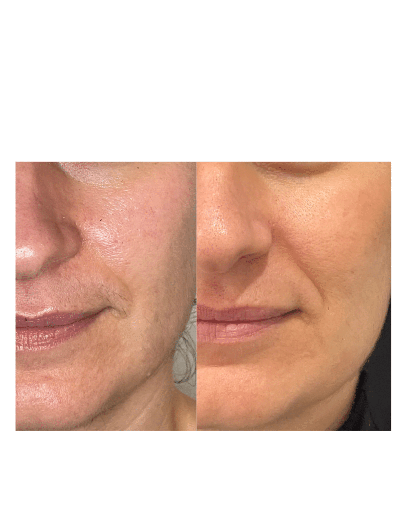 Before and After Image: Acne (Profractional Laser) - front
