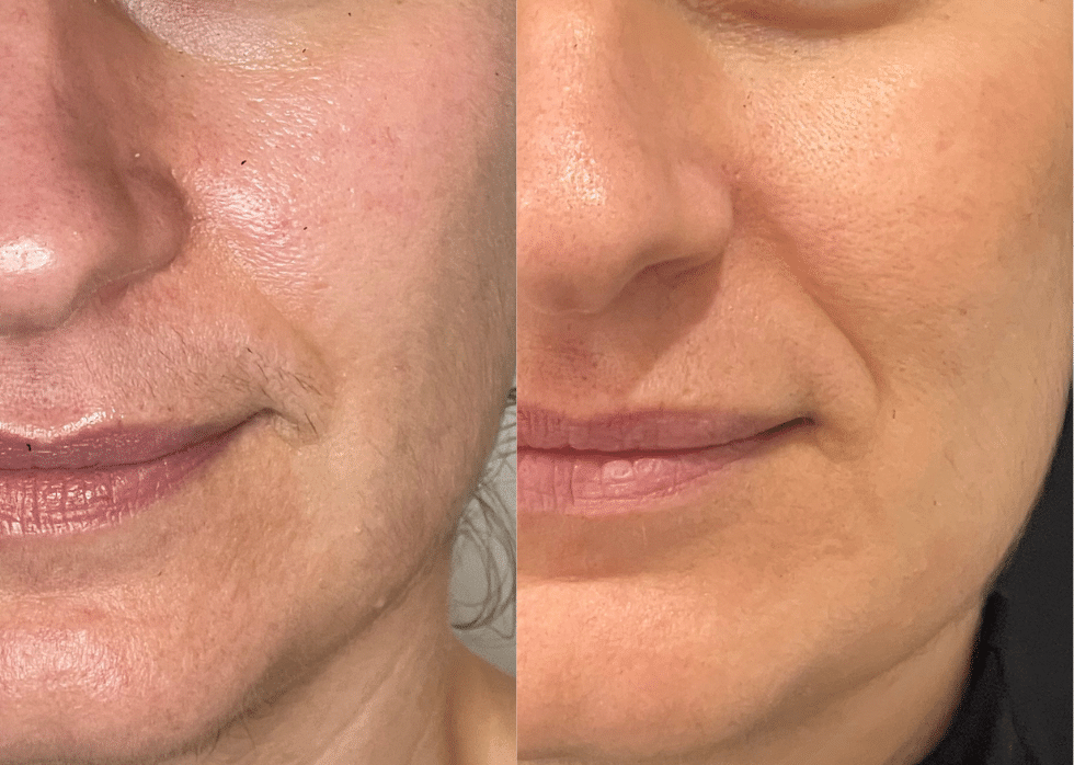 Before and After Image: Acne (Profractional Laser) - front