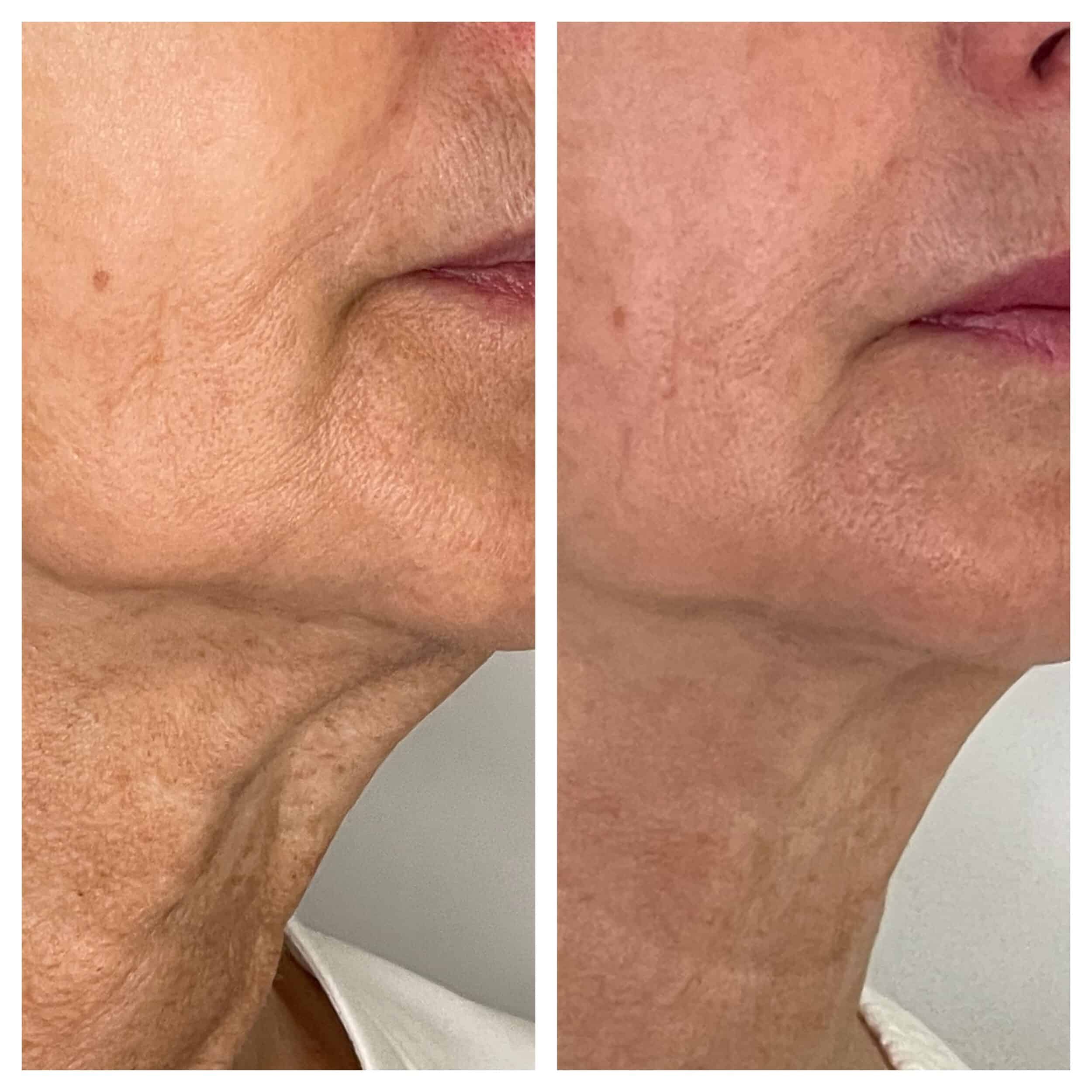 Before and After Image: SkinTyte - right-front-oblique