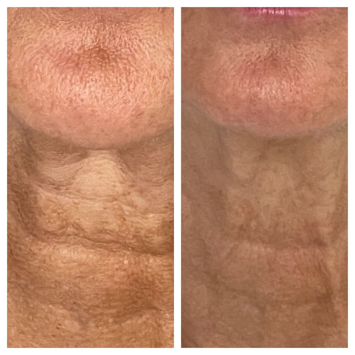 Before and After Image: SkinTyte - front