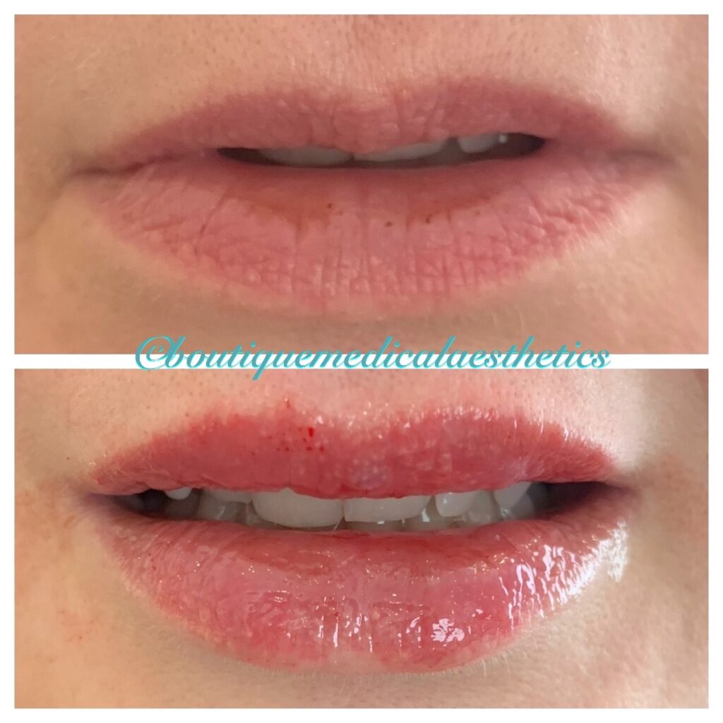 Before and After Image: Dermal Fillers - front
