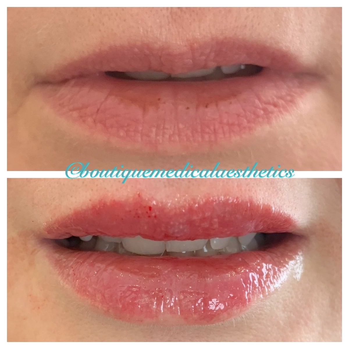 Before and After Image: Dermal Fillers - front