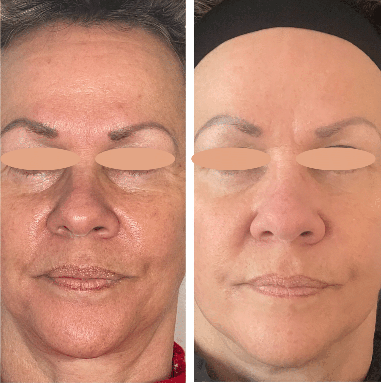 Before and After Image: Forever Young BBL and MicroLASERpeel (Arctic Peel) - front