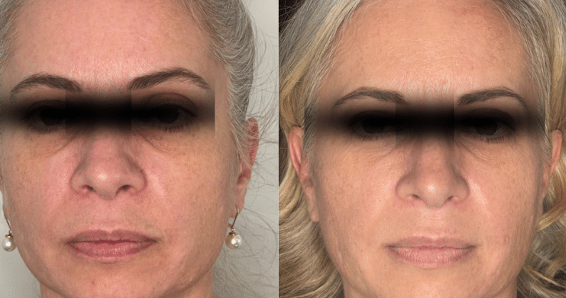 Before and After Image: Microneedling - front