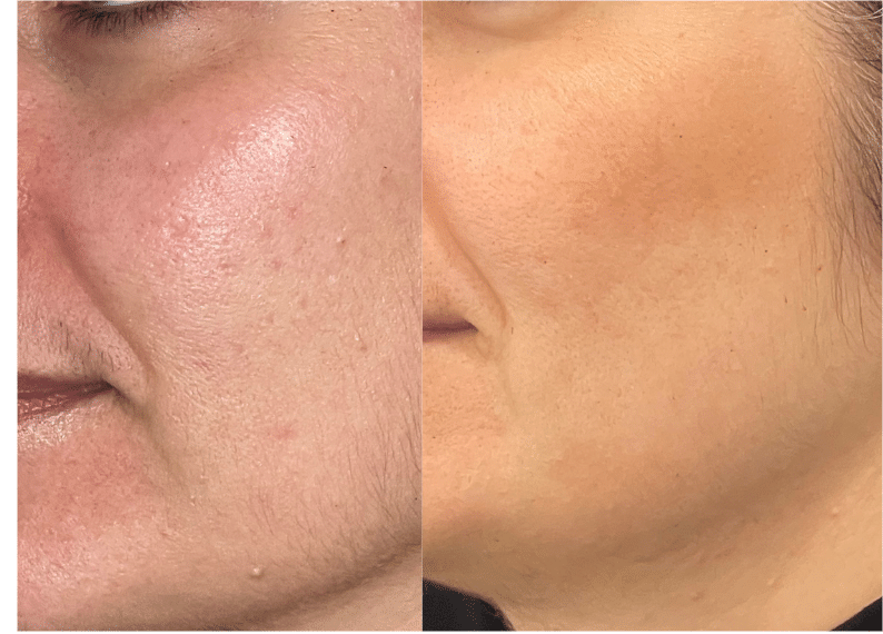 Before and After Image: Acne (Profractional Laser) - left-front-oblique