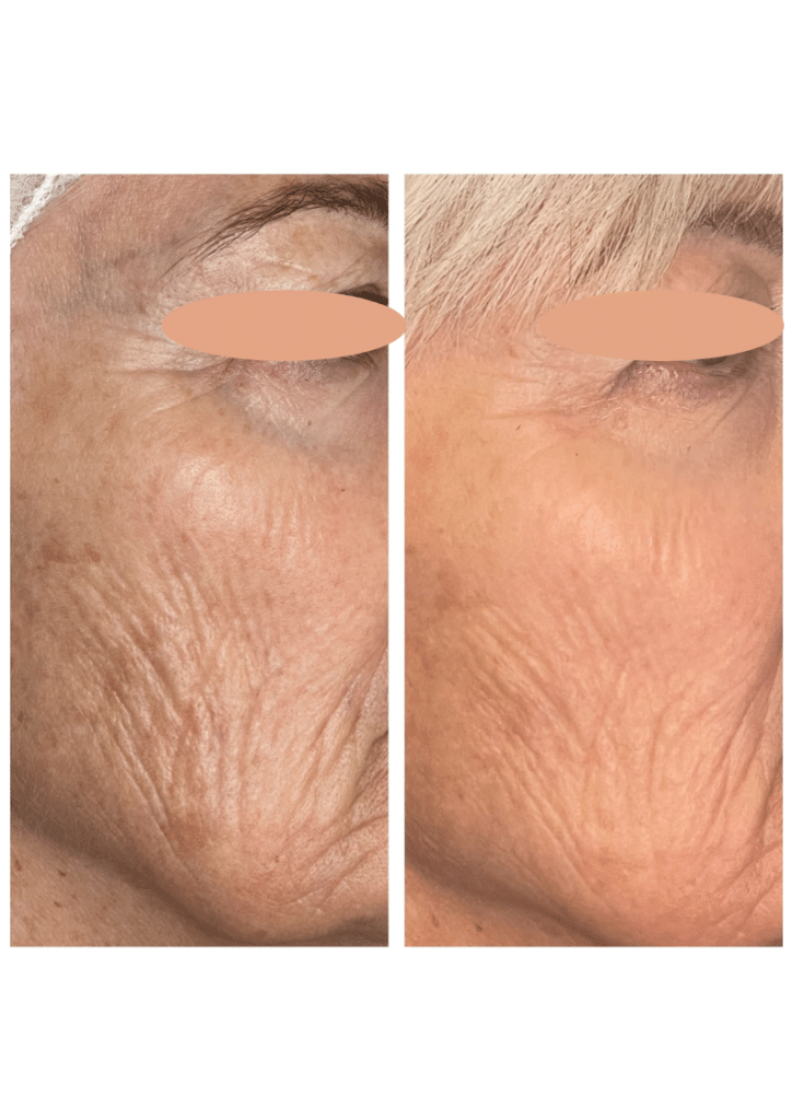 Before and After Image: BBL - front