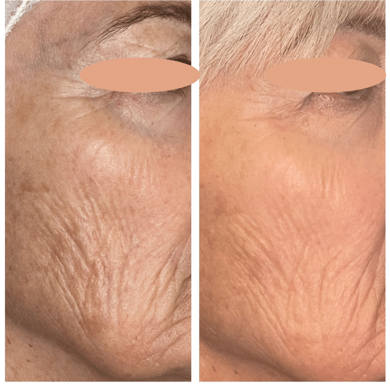 Before and After Image: BBL - front