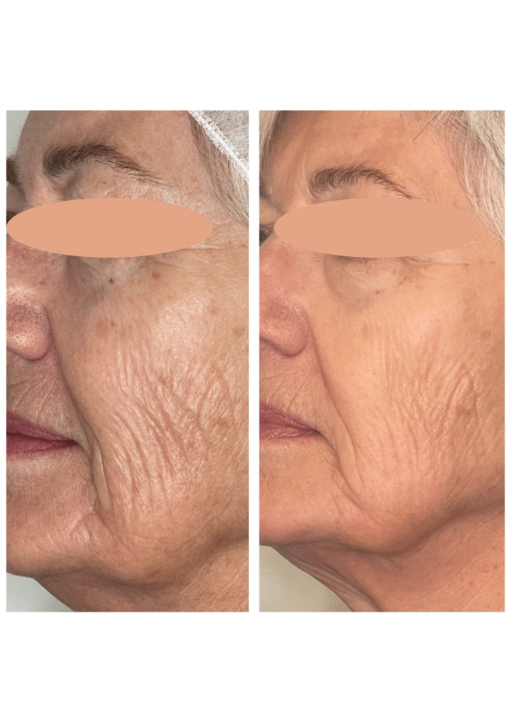 Before and After Image: BBL - front