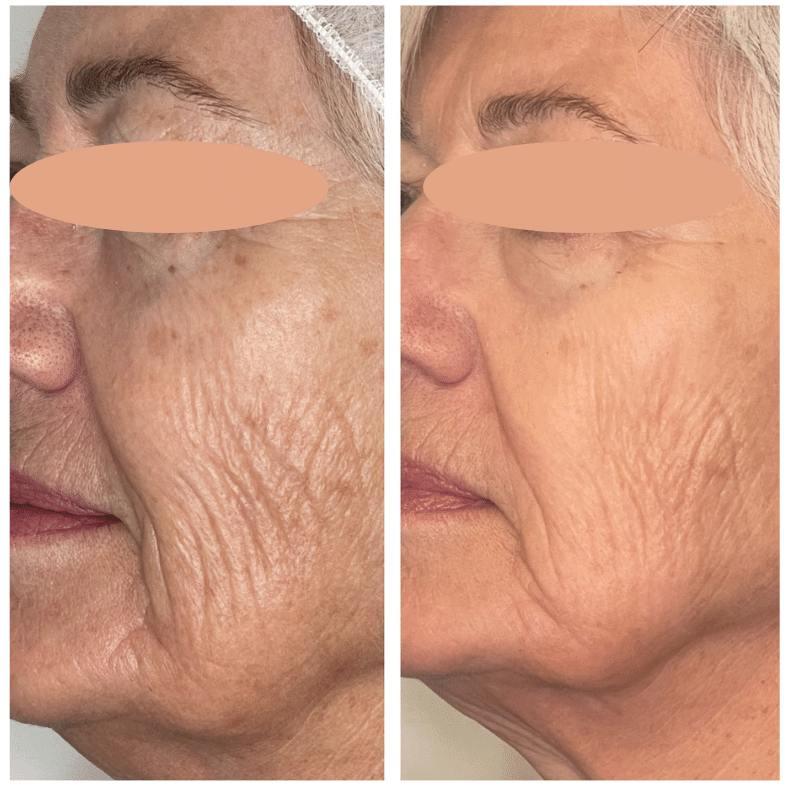 Before and After Image: BBL - front