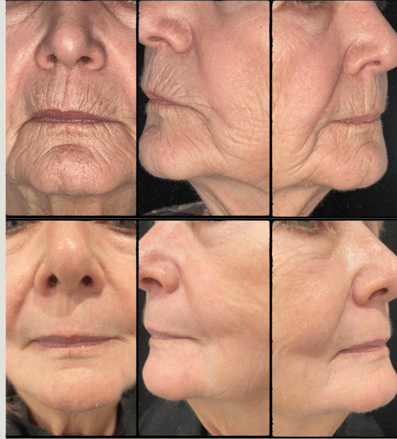 Before and After Image: Contour TRL - front
