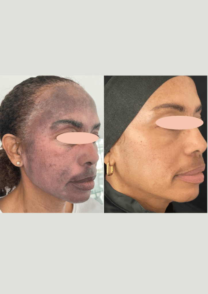 Before and After Image: Melasma - front