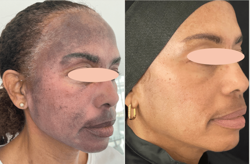 Before and After Image: Melasma - front