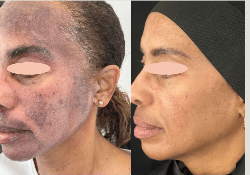 Before and After Image: Melasma - front