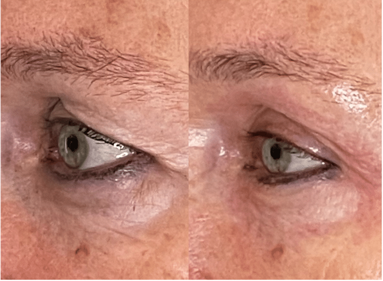 Before and After Image:  PlasmaIQ  - front